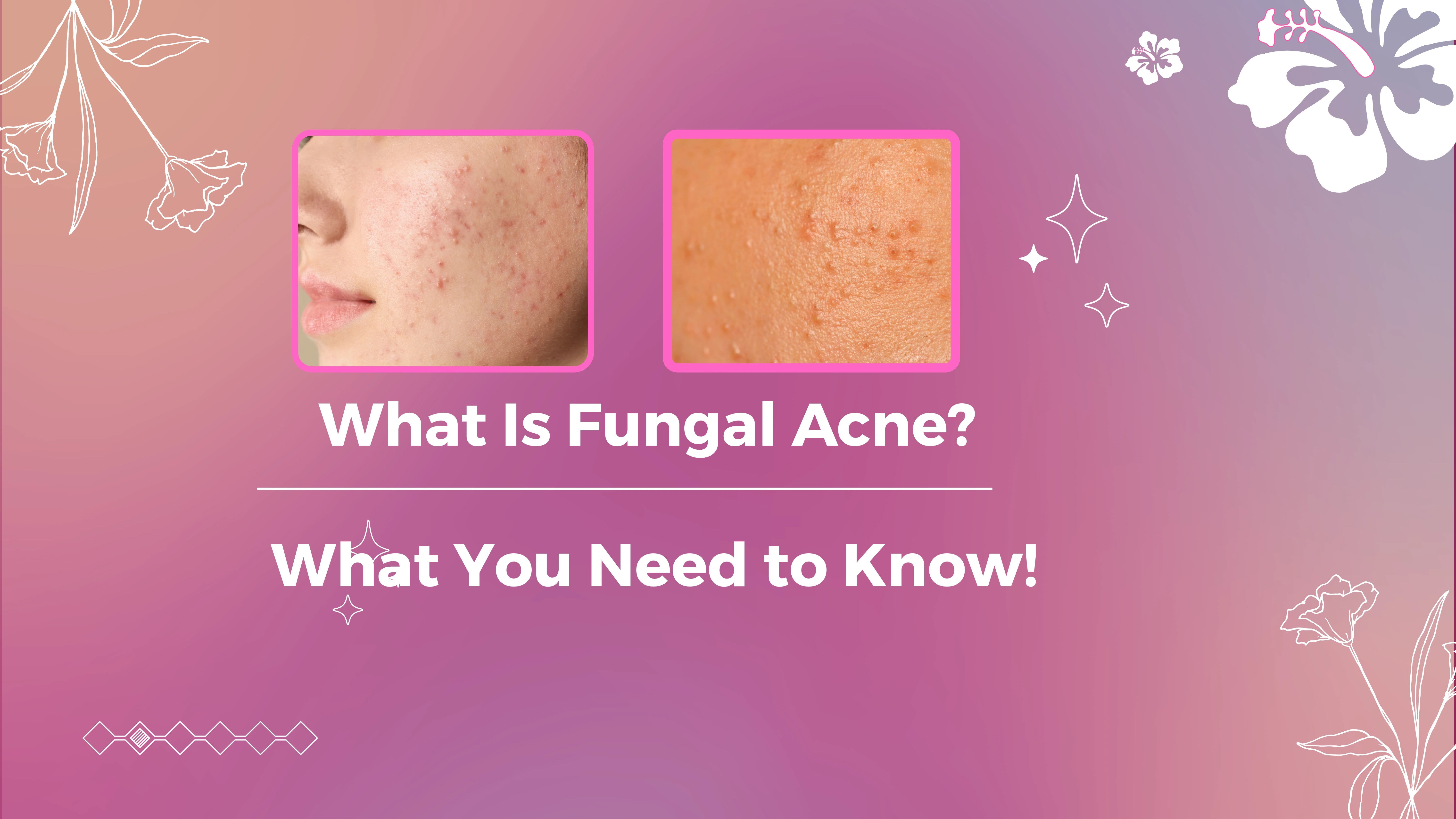 What Is Fungal Acne? Here’s What You Need to Know!